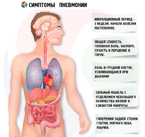 Острая пневмония симптоматика